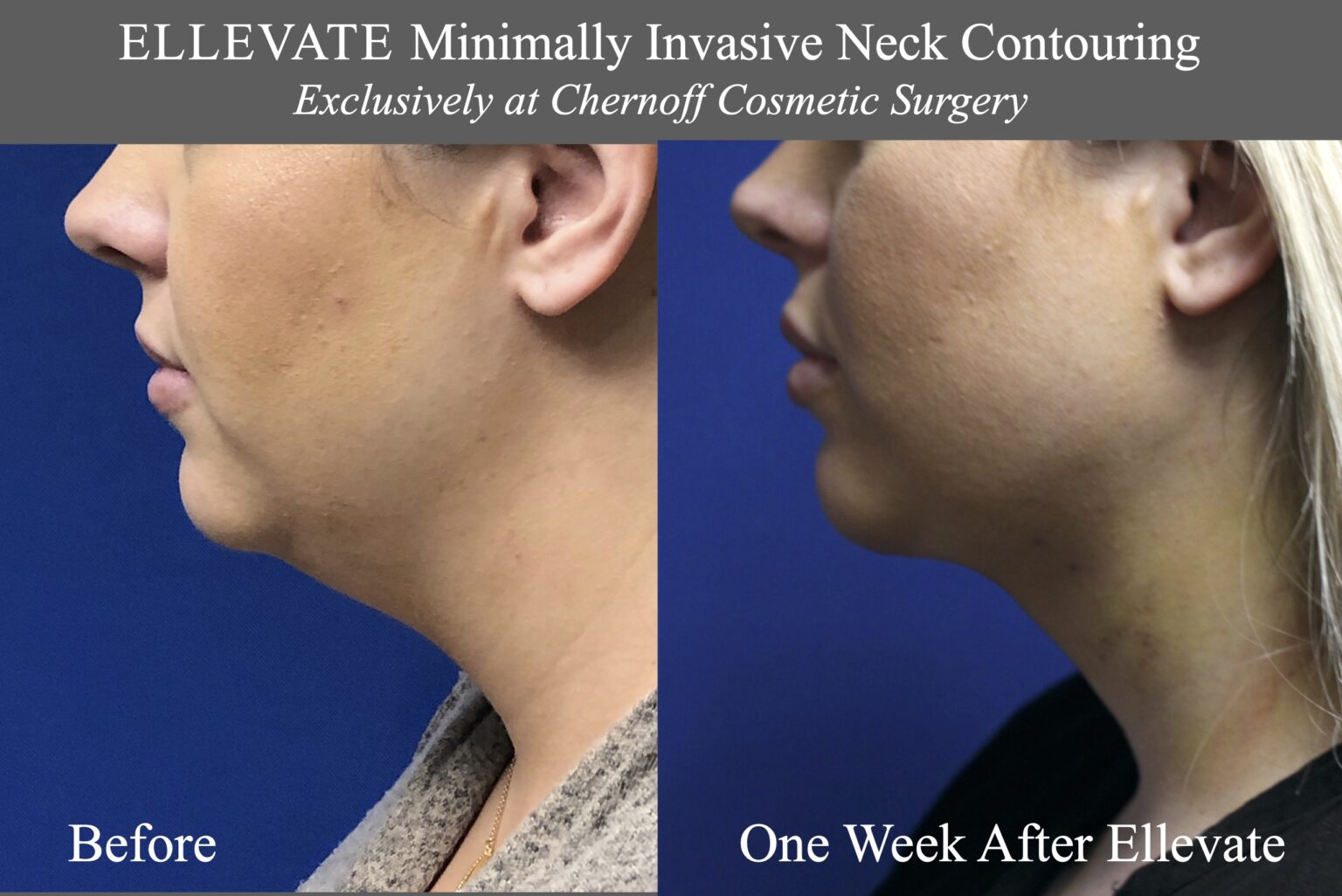 AF_Before_After_Ellevate_3-1536x1026