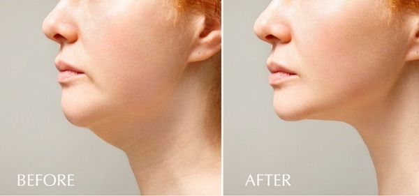submental-lipo-before-and-after