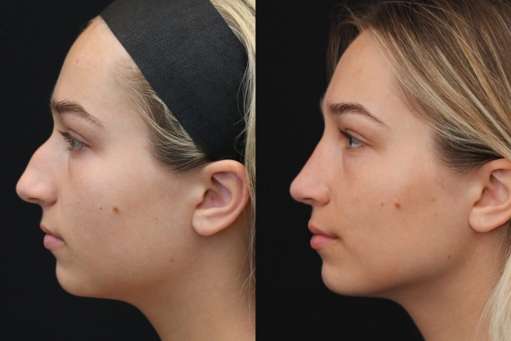 laser device in use during wrinkle treatment in Indianapolis