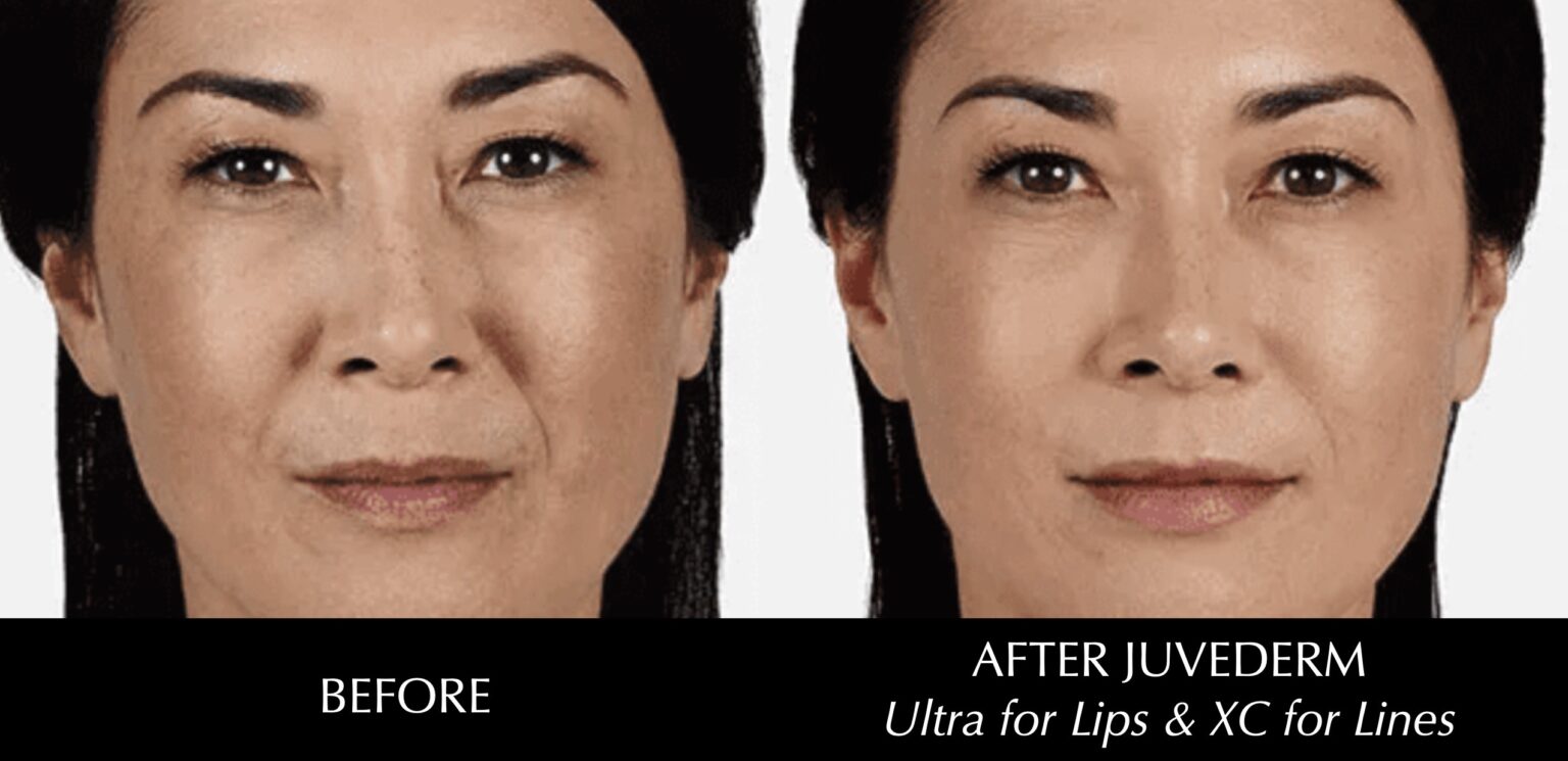 juvederm indianapolis