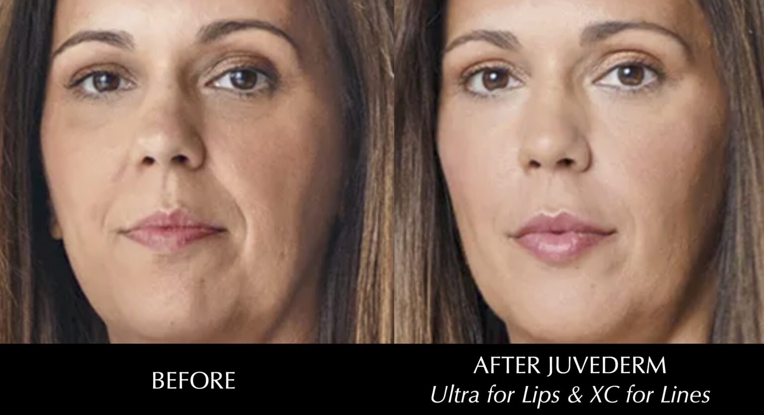 juvederm indianapolis