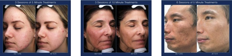 Indianapolis Cryofacial Chernoff