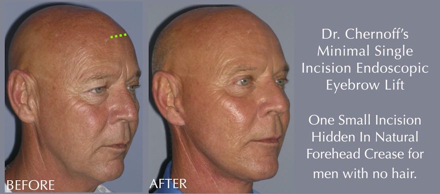 Chernoff Cosmetic Indianapolis