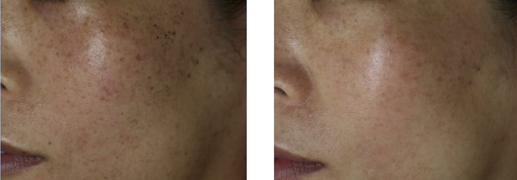 Indianapolis Pigment Removal Chernoff