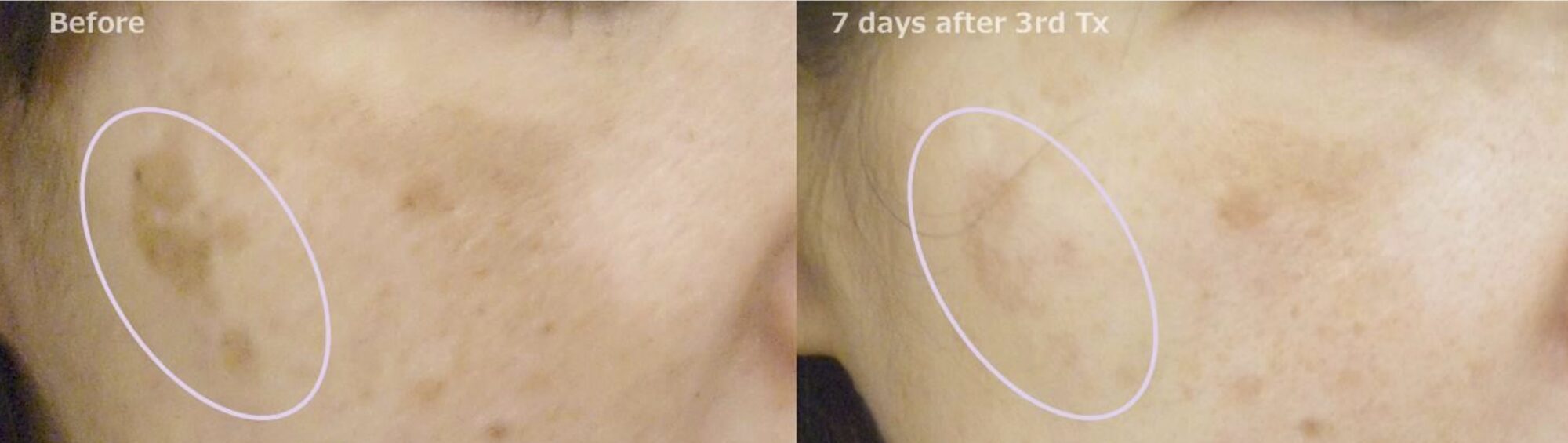 Indianapolis Pigment Removal Chernoff