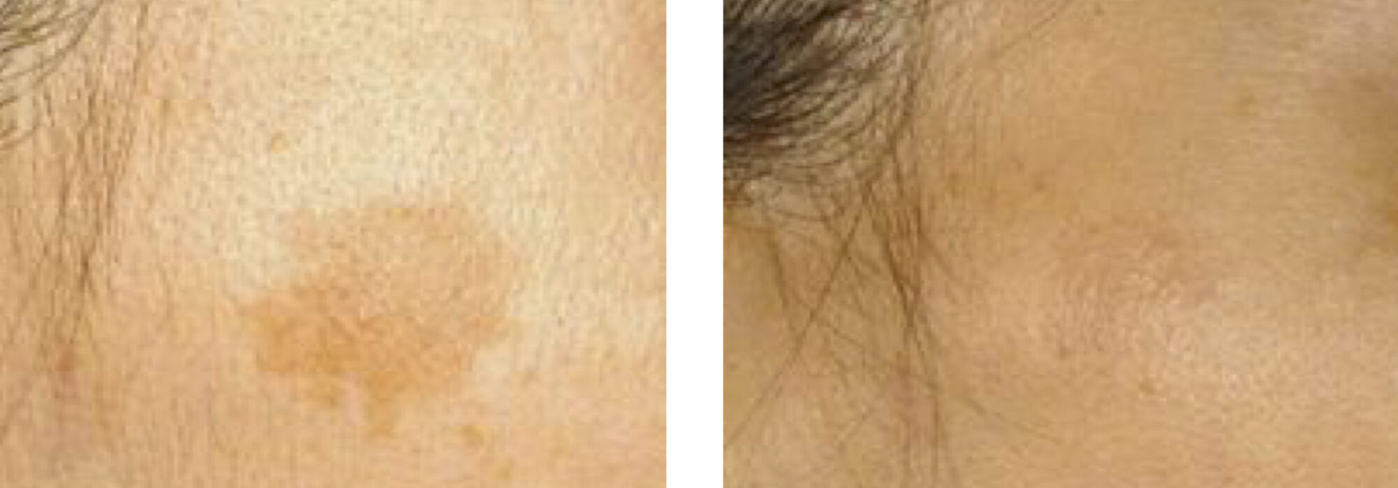 Indianapolis Pigment Removal Chernoff