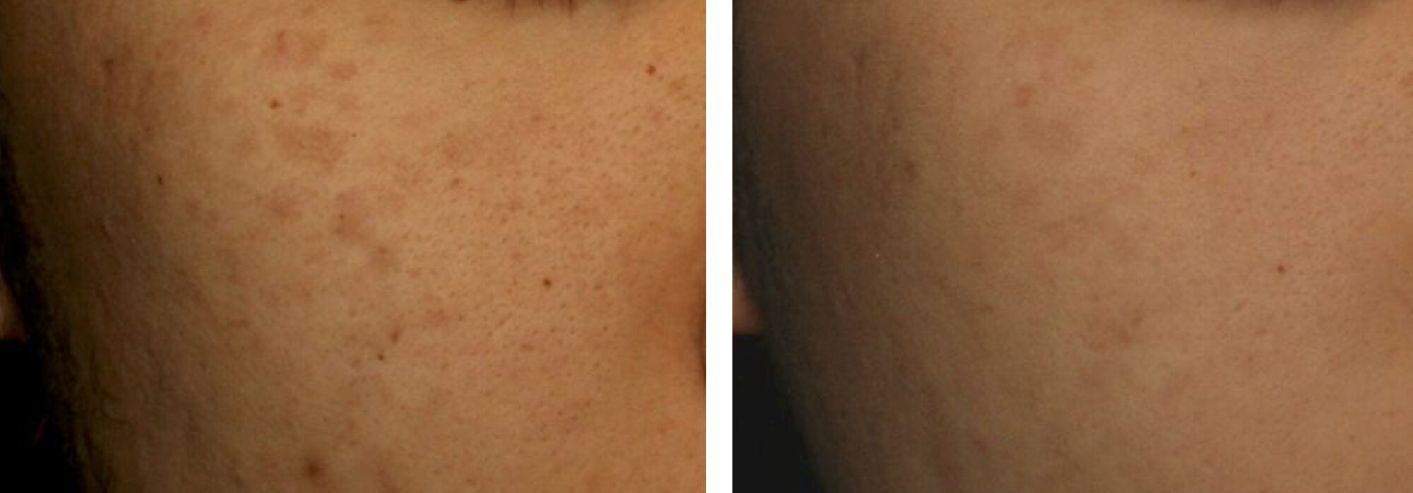 Indianapolis Pigment Removal Chernoff