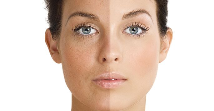 Indianapolis Melasma Chernoff