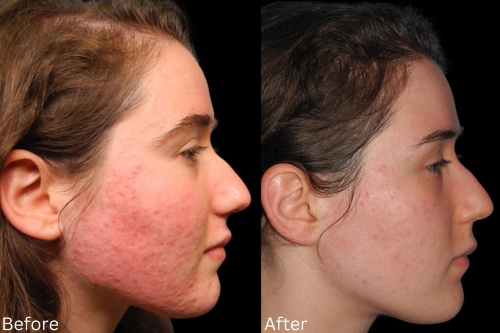 Acne7