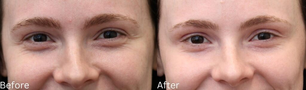 Botox7