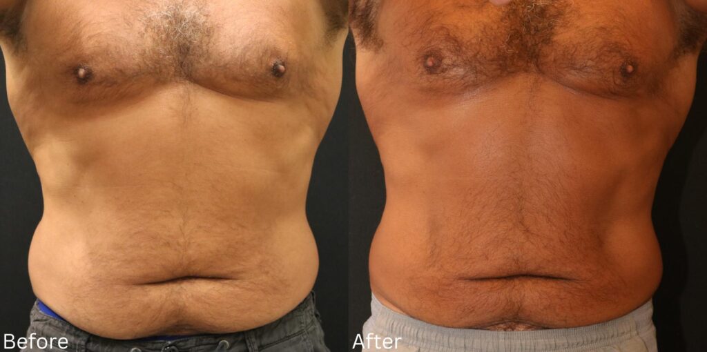 CoolSculpting6