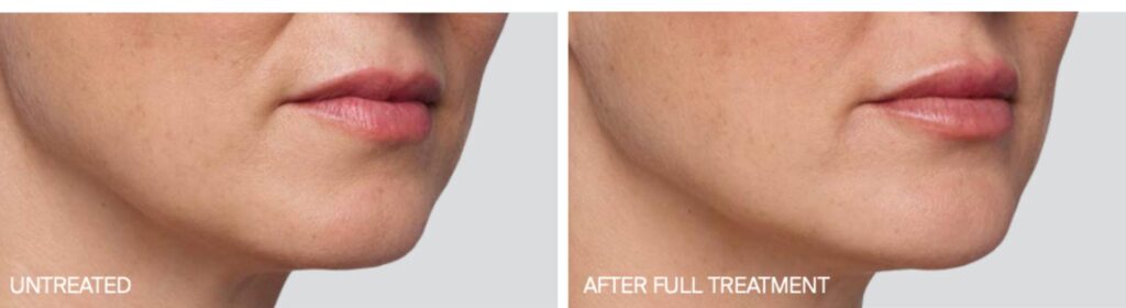 Juvederm1