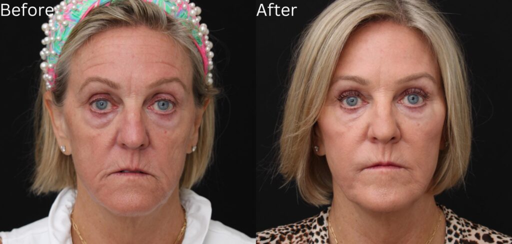Juvederm3