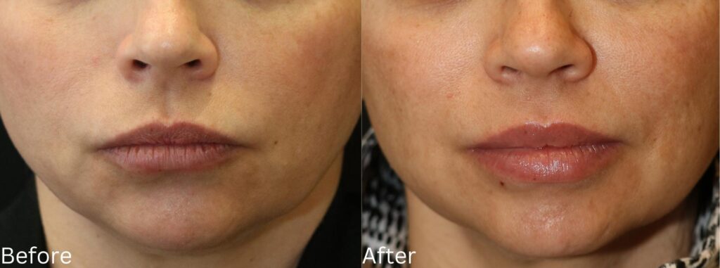 Juvederm6
