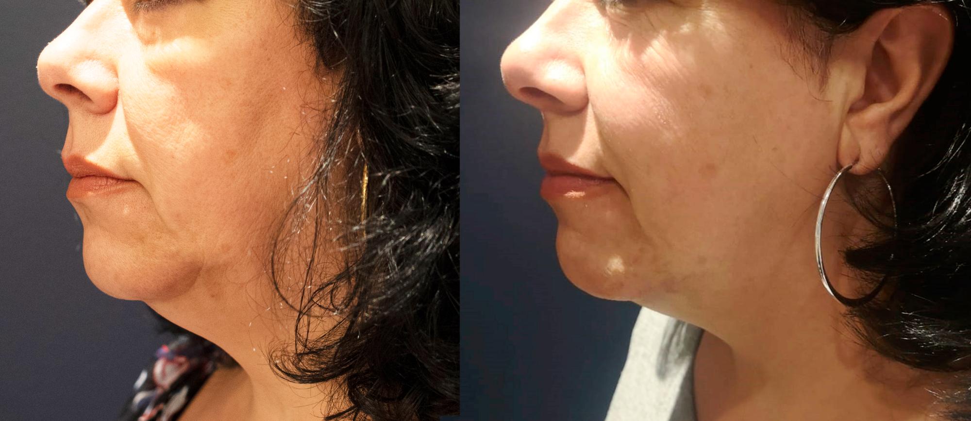 Indianapolis Morpheus Skin Tightening Chernoff