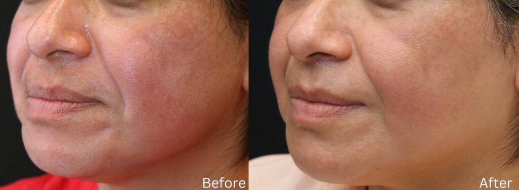 PigmentRemoval1 (1)