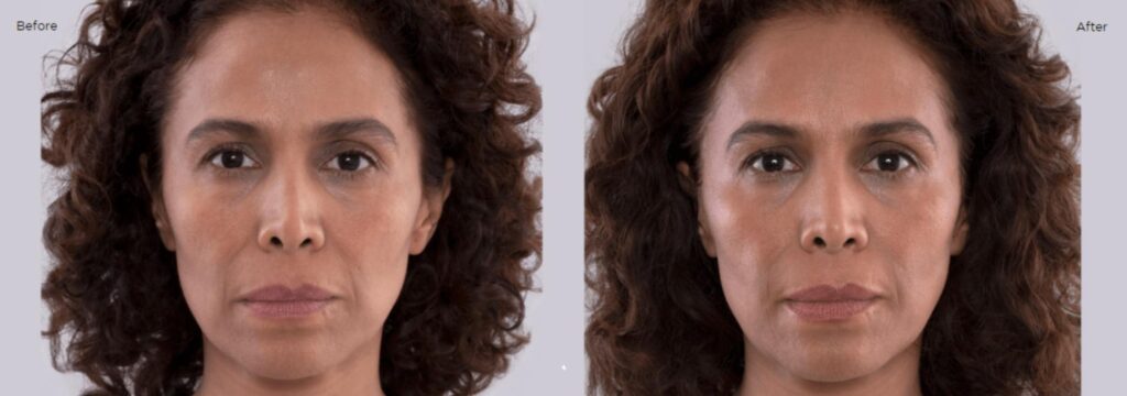 Sculptra5