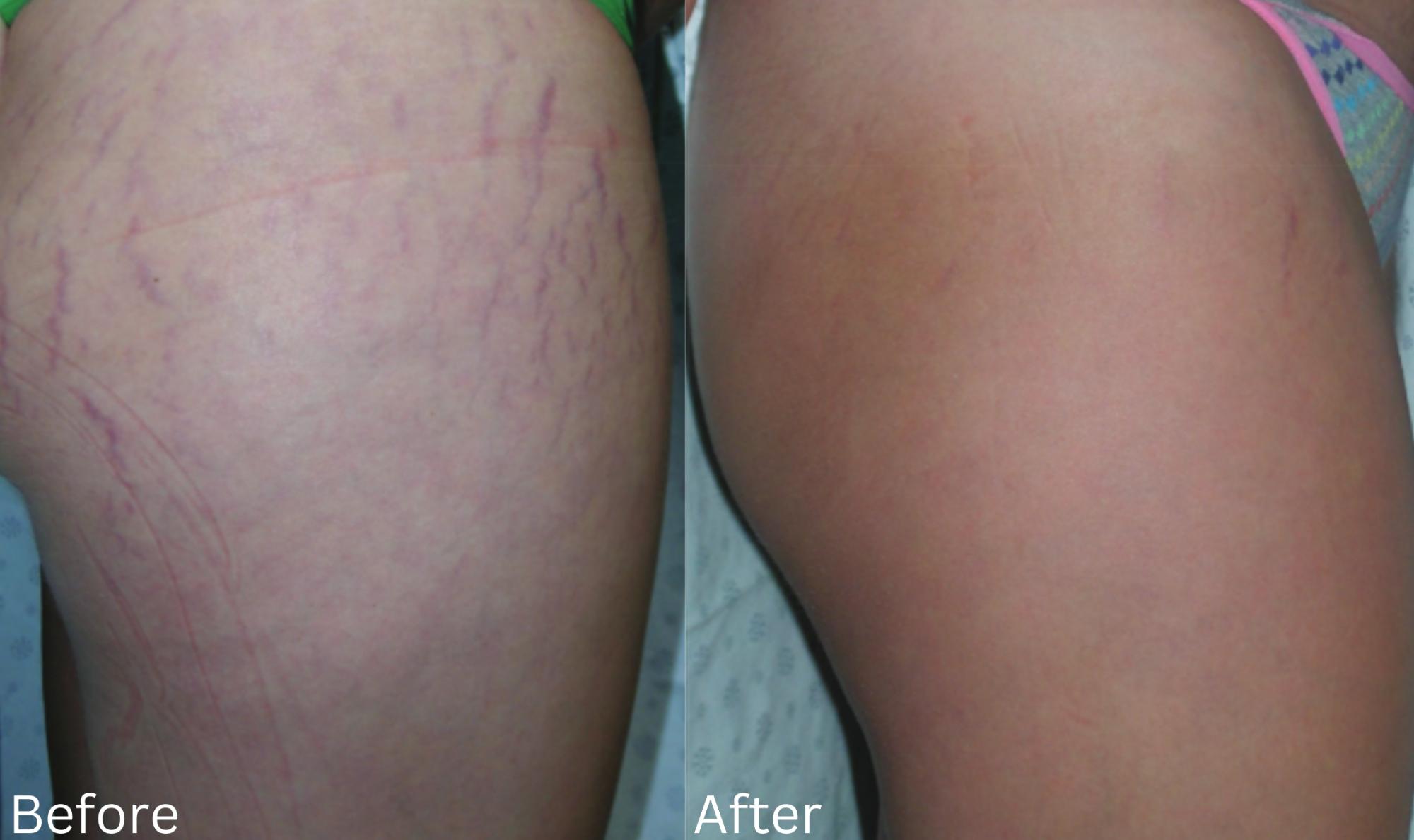 Stretchmarks1 (1)