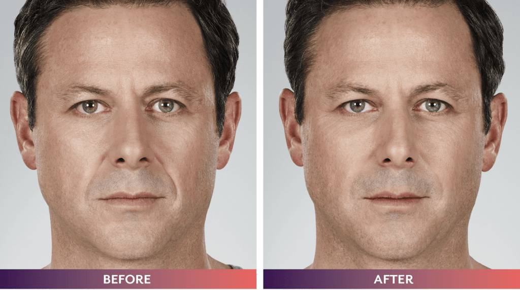 Voluma4