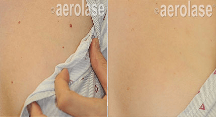 Veins & Lesions