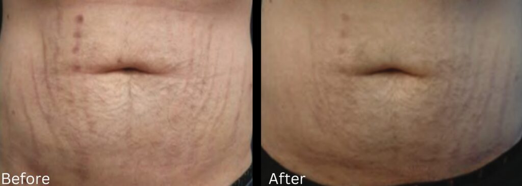 stretch marks