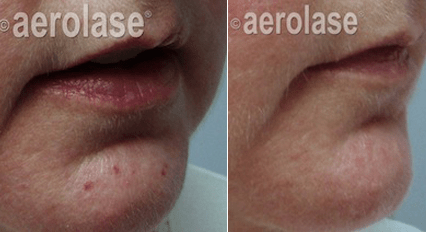 Veins & Lesions