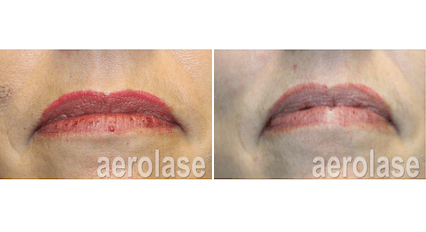Veins & Lesions
