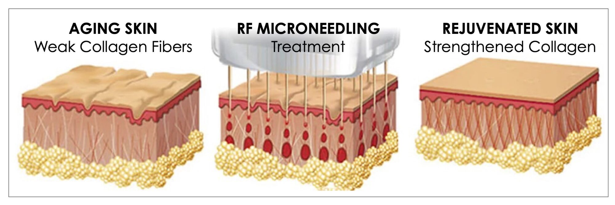 Morpheus8_RF_Microneedling_Chernoff