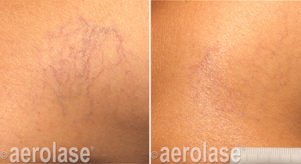 Veins & Lesions