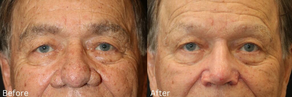 Rhinophyma
