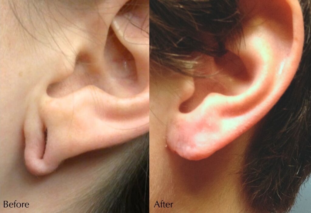 Earlobe Repair - 1