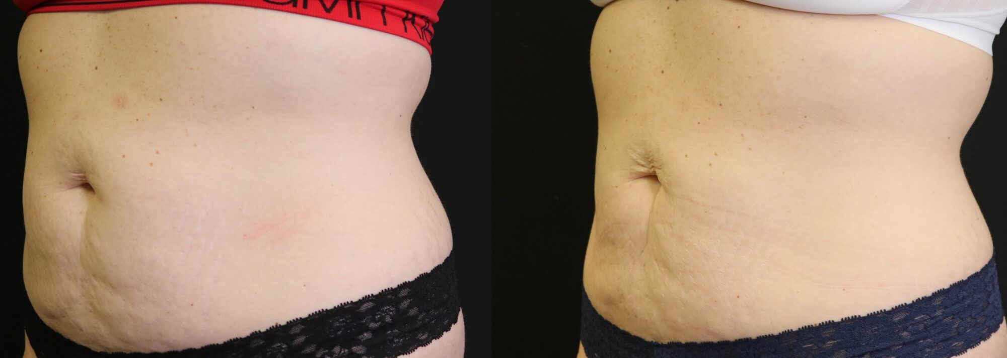 Non-surgical skin tightening Indiana