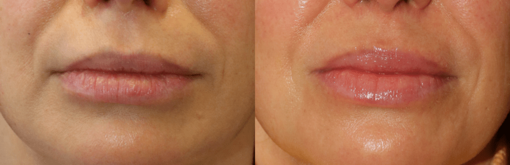 Lip Filler – Volbella