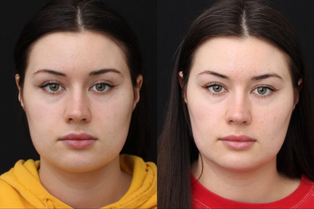 Buccal Fat Removal