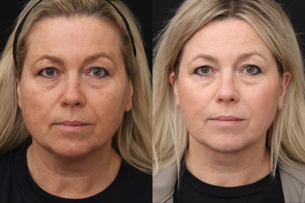 Face/Neck lift