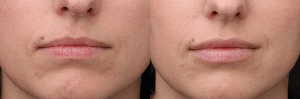 Lip Filler (Redensity)