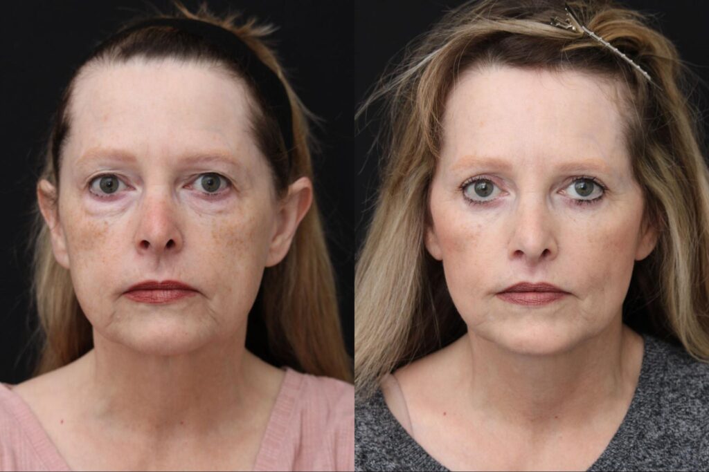 Upper and Lower Bleph, Face Neck Lift, and lip lift