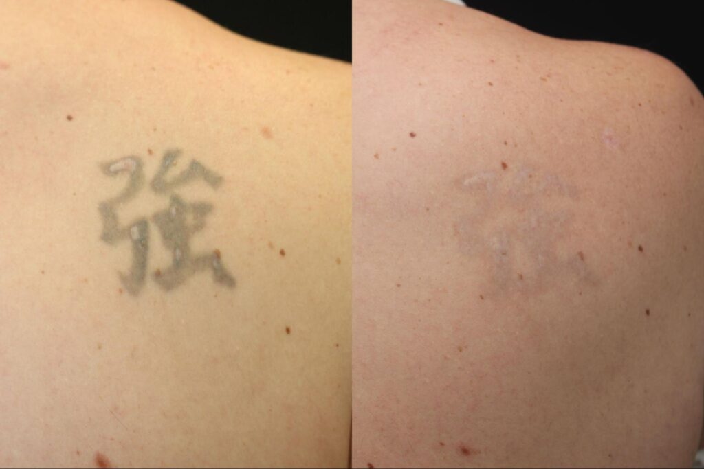 tattoo Removal