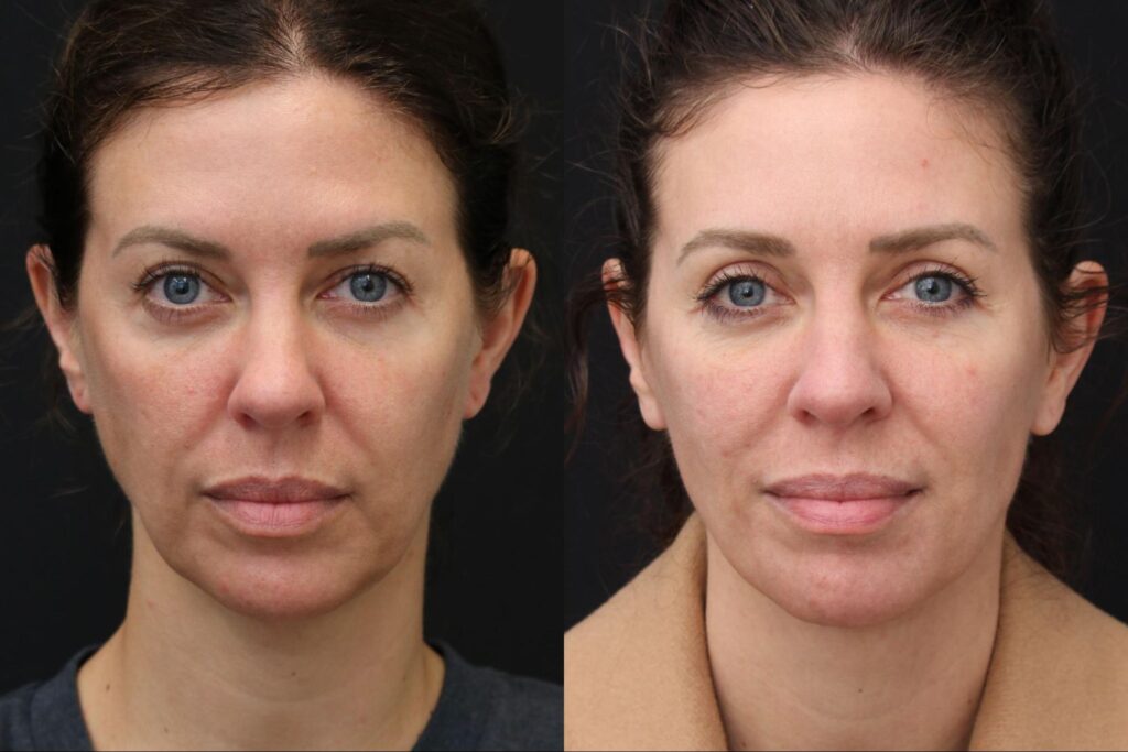 Face/Neck lift and Upper Bleph