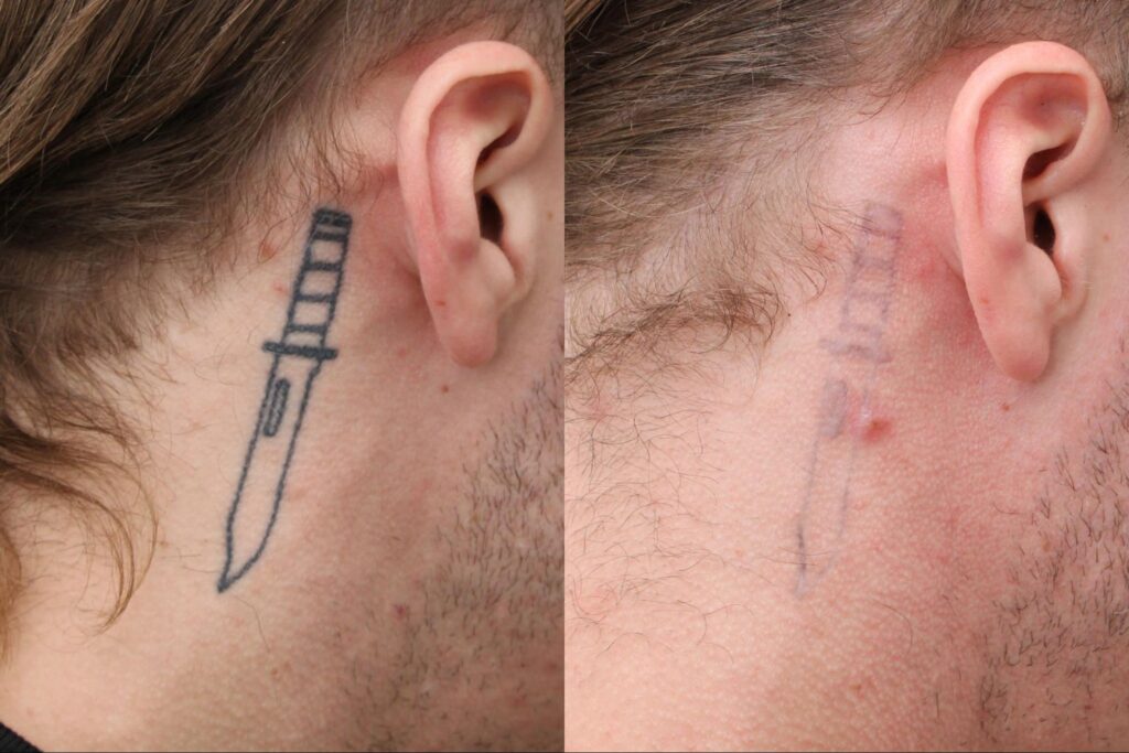 Tattoo Removal