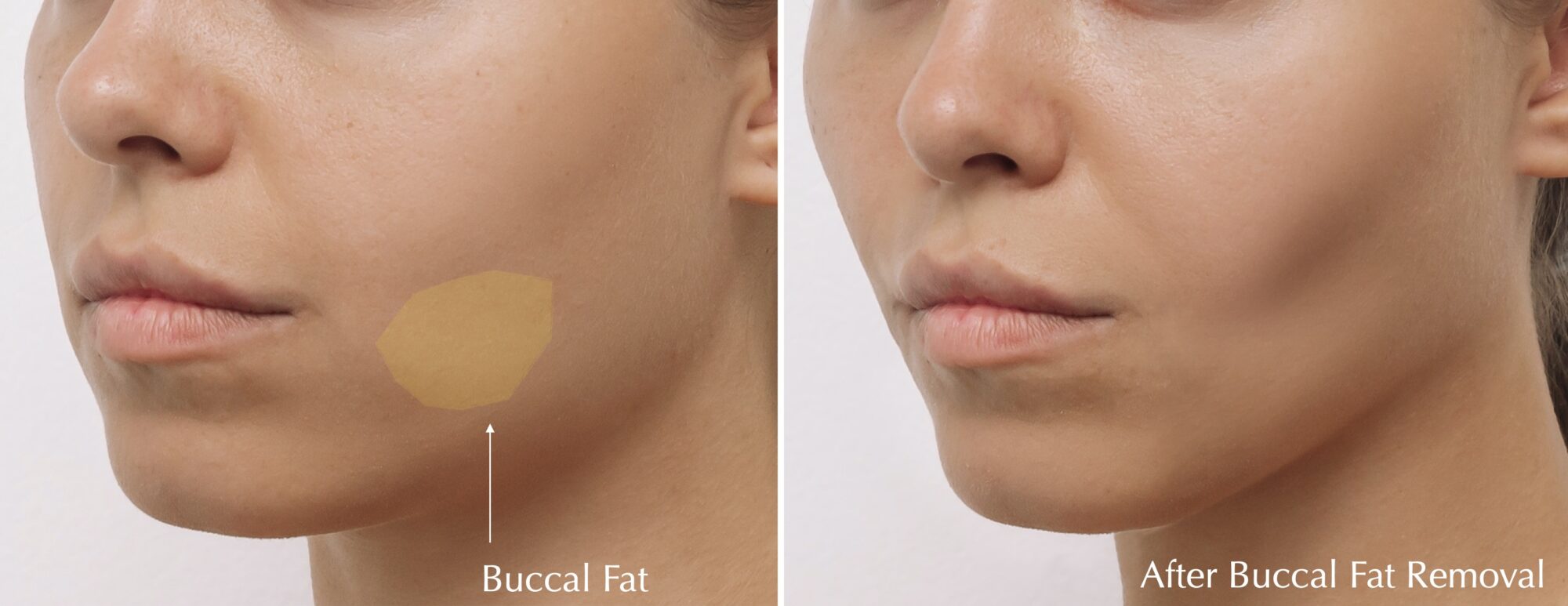 Buccal_Fat_Chernoff_2