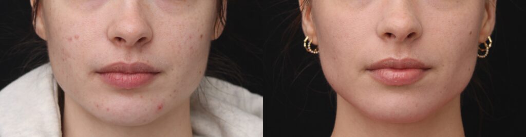 Face Reality Acne Bootcamp Chernoff Cosmetic Surgery Before and After