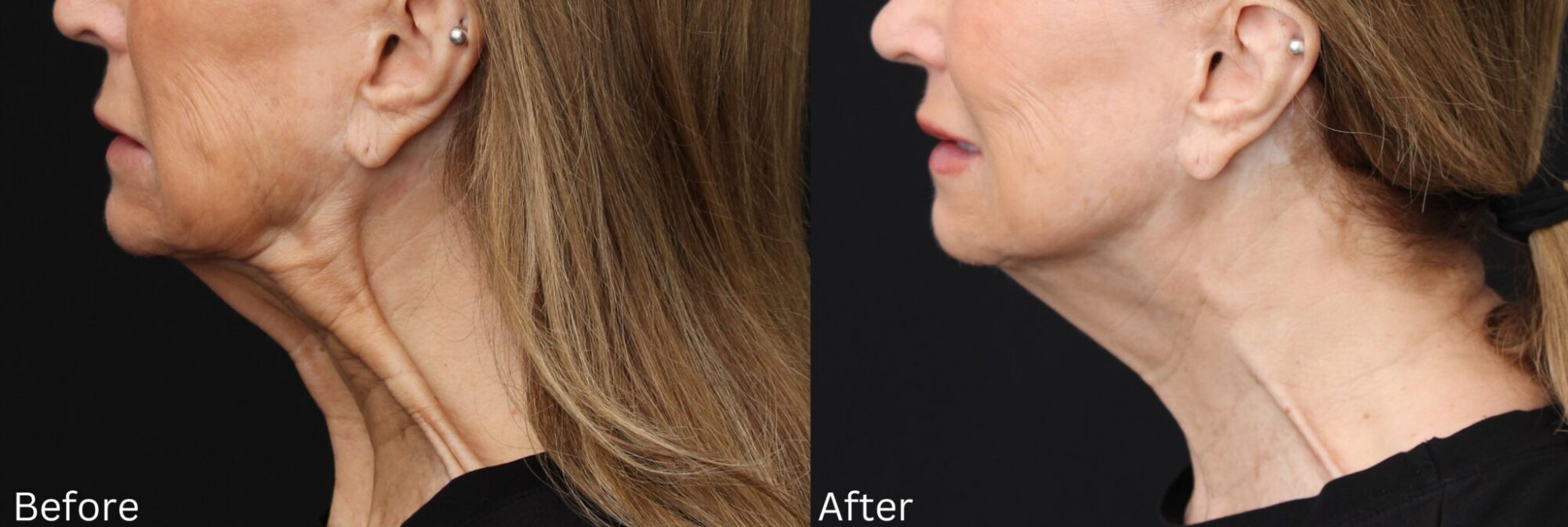 Botox3B-2048x689